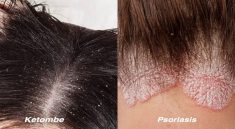 Psoriasis vs Ketombe Cara Mengenalinya dan Pengobatan