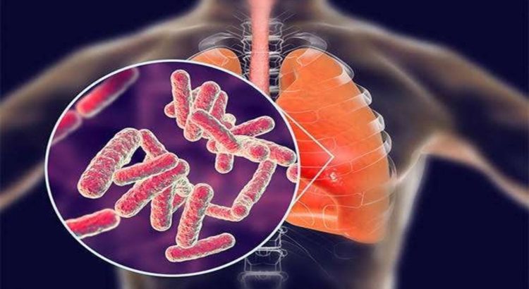Tuberkulosis Masih Menjadi Tantangan Kesehatan Nasional