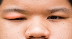 Kelopak Mata Bengkak, Bisa Menjadi Tanda Sindrom Nefrotik