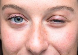 Myasthenia Gravis Penyakit Autoimun yang Mengancam Nyawa