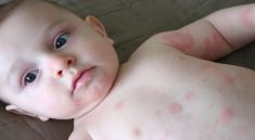 Biduran Penyebab, Penanganan, dan Kapan Harus ke Dokter