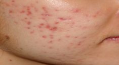 Bopeng Jerawat Penjelasan dan Cara Mengatasinya