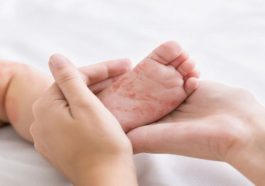 KLB Campak di Indonesia Ancaman Serius Jika Imunisasi Turun