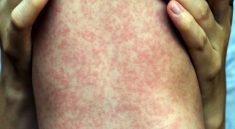 Penyakit Campak Jangan Remehkan, Menular dan Berakibat Fatal